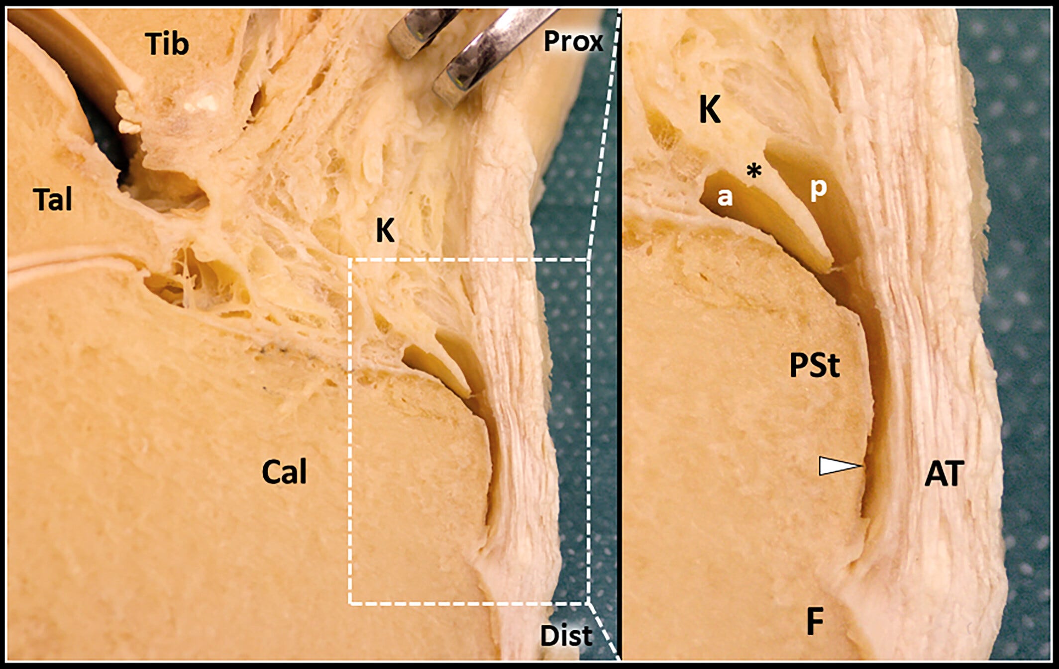 Bursa retrocalcanea 1 Tempo Formacion ecografia.jpg